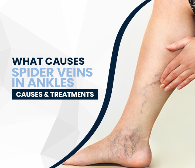What Causes Spider Veins in Ankles