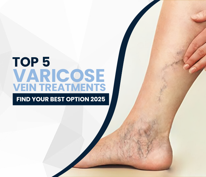 varicose vein treatments