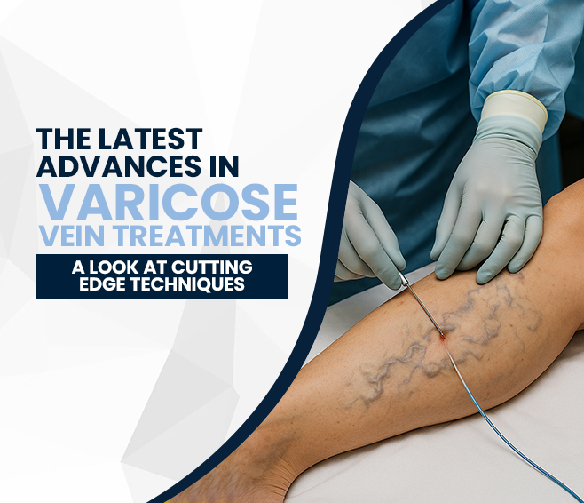the latest advances in varicose vein treatments