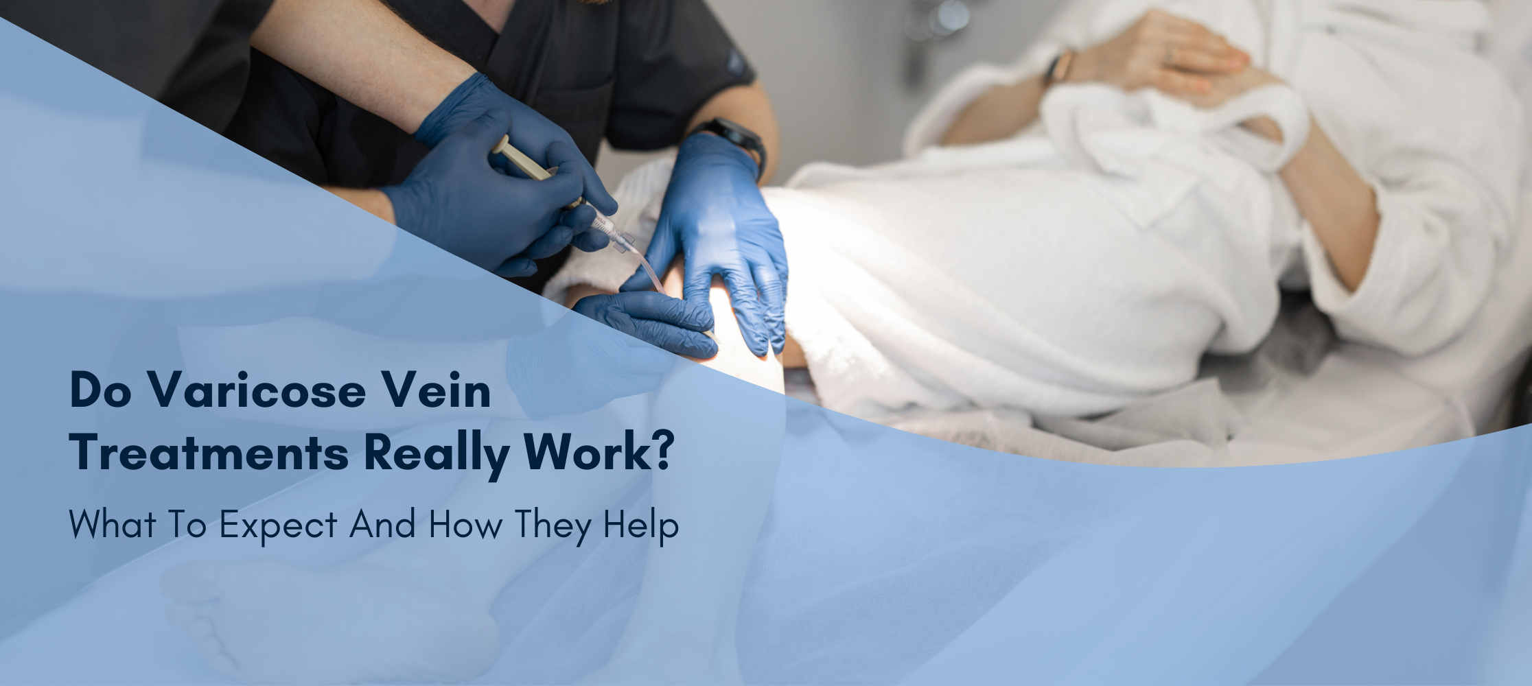 Do Varicose Vein Treatments Really Work What To Expect And How They Help