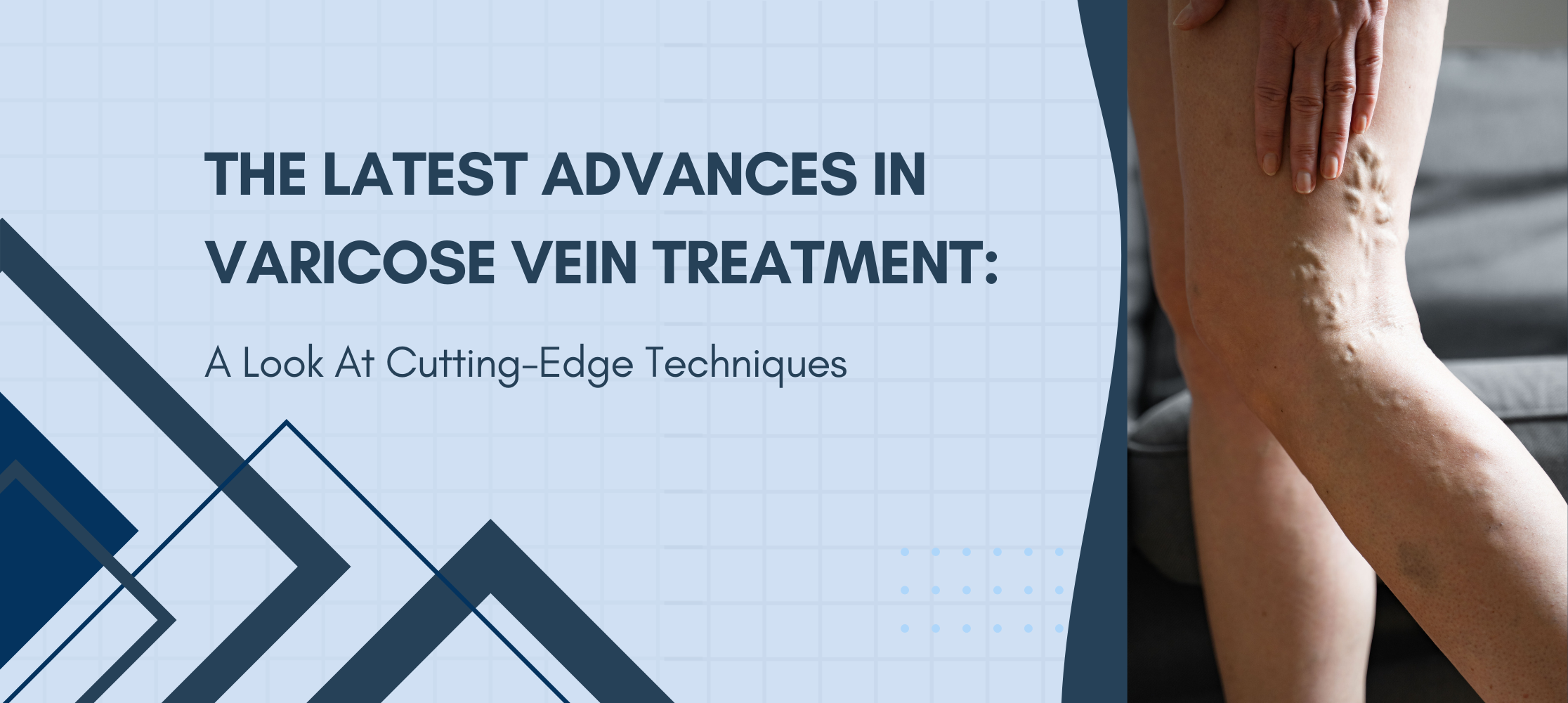 The Latest Advances In Varicose Vein Treatment – A Look At Cutting-Edge Techniques