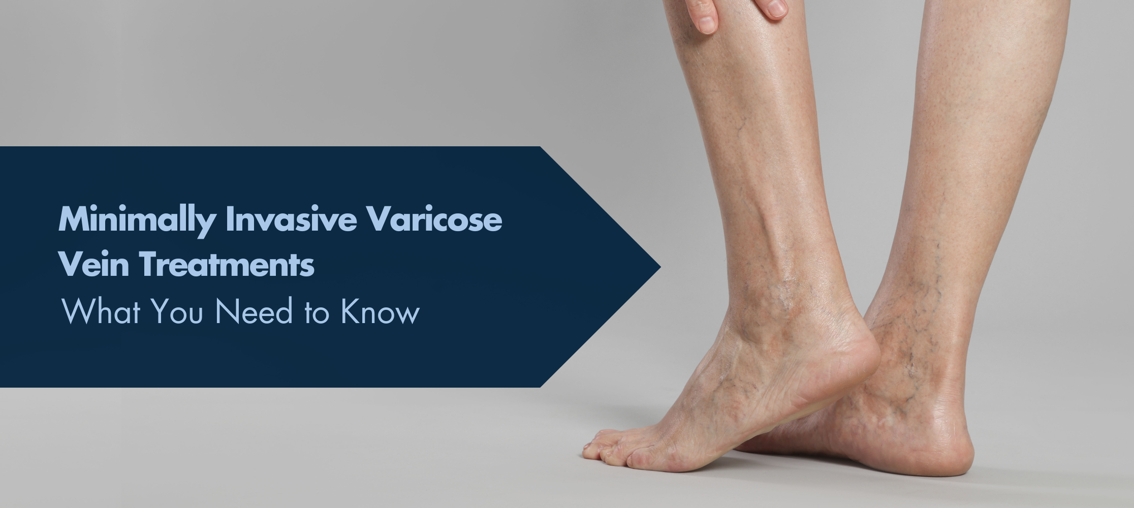 Minimally Invasive Varicose Vein Treatments - What You Need to Know